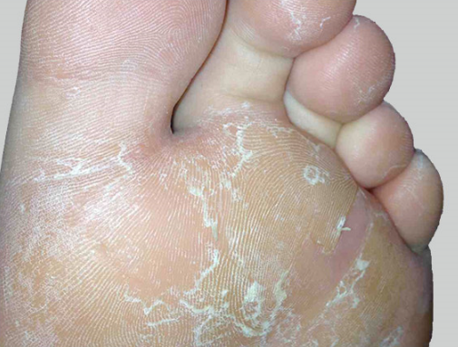 Athlete’s Foot