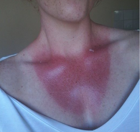 Sunburn Massage Oil