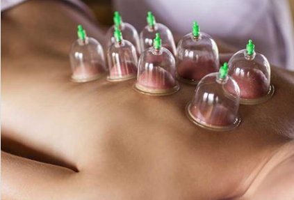 Cupping Therapy